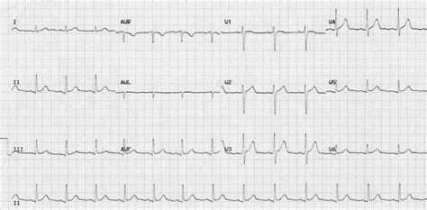 ecg 12 lead normal|Normal Sinus Rhythm • LITFL Medical Blog • ECG .